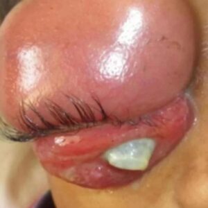 Lo esencial de la salud ocular: cómo prevenir infecciones Lo esencial de la salud ocular: cómo prevenir infecciones